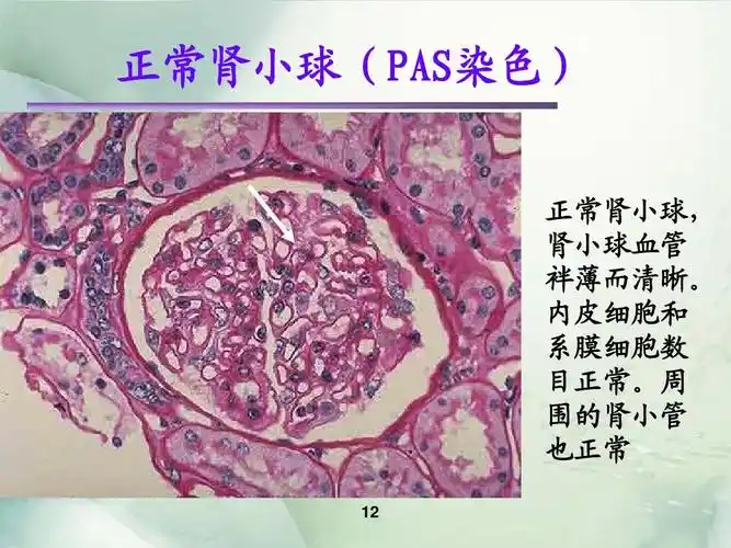 急性肾小球肾炎-内科ppt