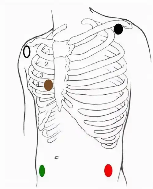 心电图操作流程和步骤五导联心电监护仪使用操作流程
