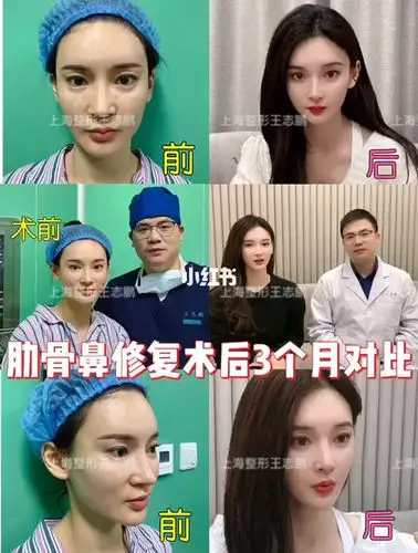 超美的肋骨隆鼻修复术后3个月对比妈生款更自然宝宝非常满意哦60