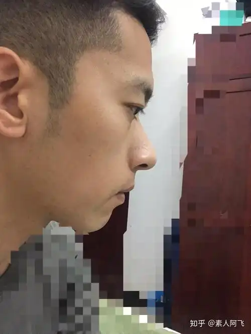 鼻子高但是山根低是什么样