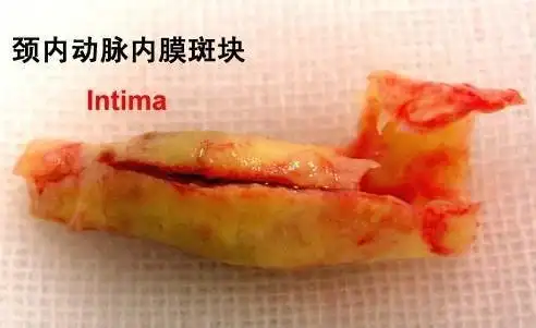 这种斑块几乎每个人都有,中老年人血管一旦被它堵住,随时致命!