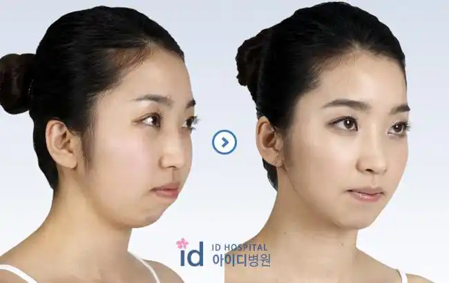 假体垫下巴有什么优势,垫下巴效果对比图