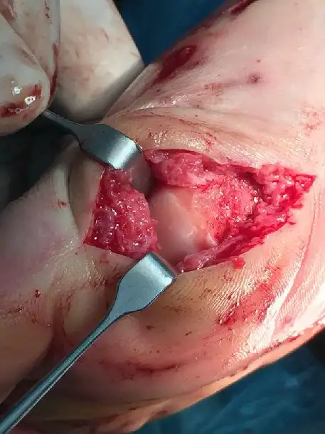 拇外翻手术,是时候跟传统大切口说再见了 - 好大夫在线