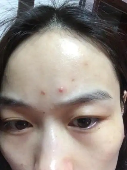 有人说青春痘?这是青春痘吗跟上一个问题的痘痘是一种类型的.