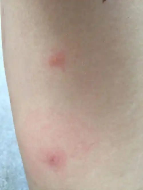 起床后就这样了,后来看到一只小蜘蛛在床上,估计是小蜘蛛咬的,硬的