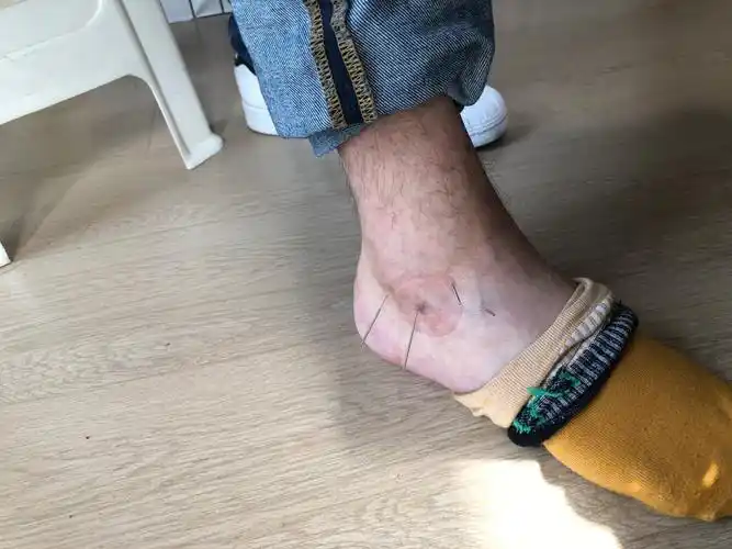 走道扭伤第一时间针灸放xue治疗