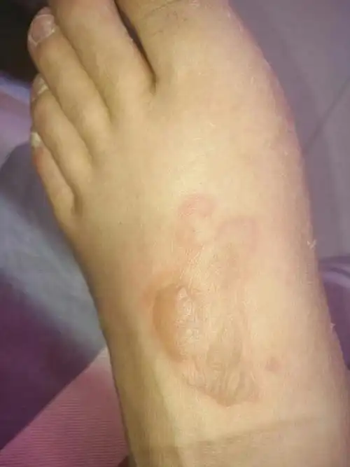 脚被蒸汽烫伤,起水泡,4天了,水泡还在,能不能挑破,会感染吗?