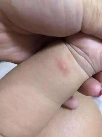 7个月的宝宝身上起这样红色的疙瘩是咋回事