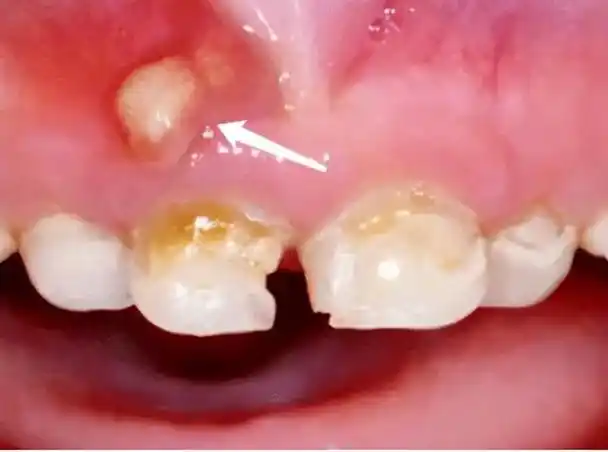 牙龈上长脓包的危害可不能小觑