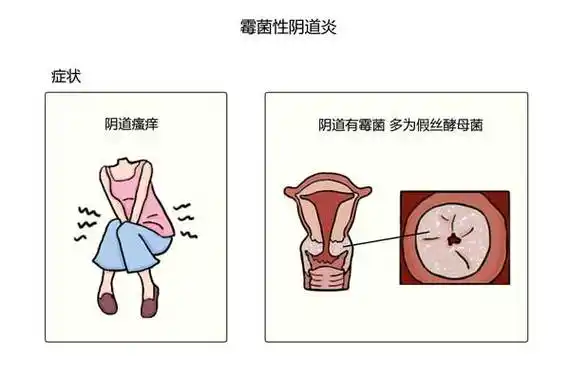 如何判断霉菌性阴道炎治愈了