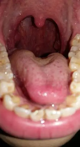 滤泡性咽炎的介绍