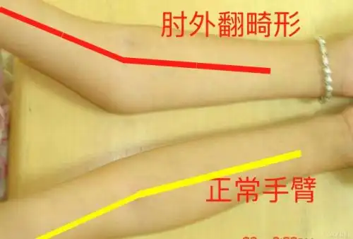 骨折复位不良,手臂这种畸形很可怕!_治疗