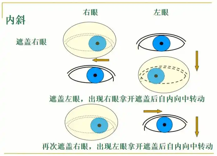 斜视有很多分类快来学习一下吧