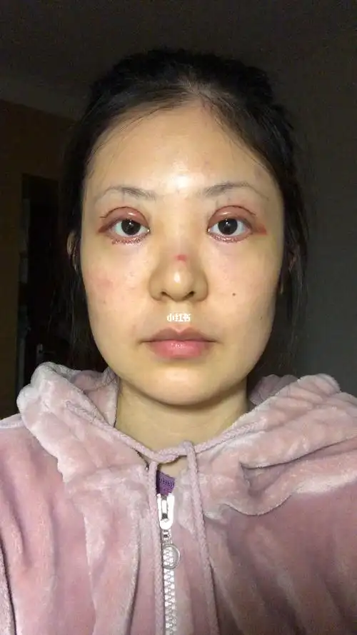 双眼皮 倒睫 -3.22术后第1天_双眼皮_鼻子_美妆_医美整形