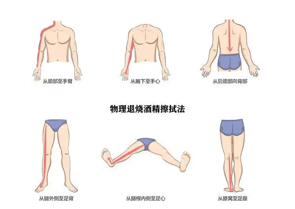物理退烧用医用酒精擦哪里