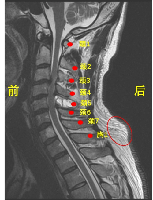 颈椎病_介绍_日常注意事项 - 好大夫在线