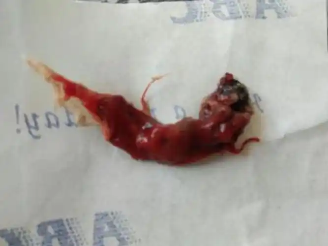 早孕药流排出的孕囊形状图片