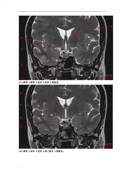 鞍区垂体mri解剖