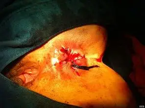 肛门长痔疮的图片初期(痔疮图片 初期)-健康-公司创