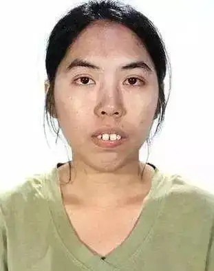 23岁泰国龅牙妹整容后变万人迷坦言以前都找不到工作