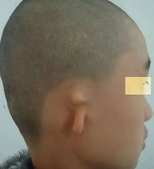 小耳畸形 - 好大夫在线