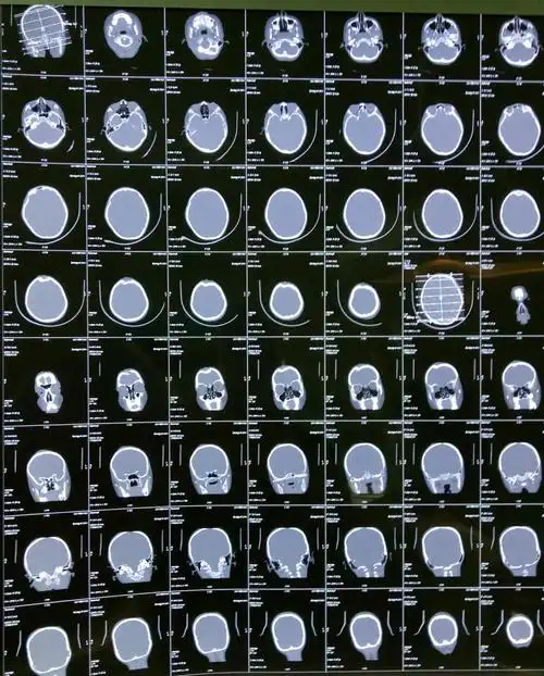 额顶部颅骨凹陷性粉碎性骨折一例