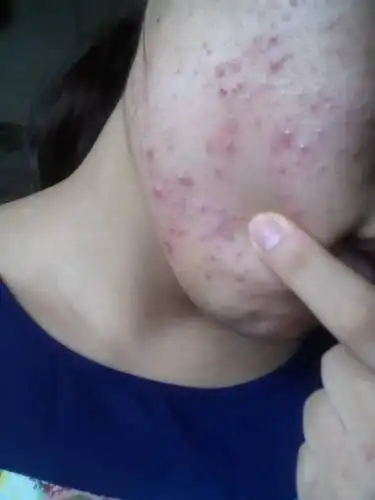 这样的痘痘怎么去呀 能不能挤 以前都只是几个痘痘今年夏天特别多满脸