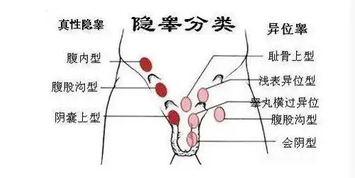 隐睾手术多少钱单侧隐睾一定要手术吗