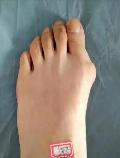 引起大拇趾往外侧弯,造成拇趾骨头向外突出,除了会挤压到其他脚趾,还