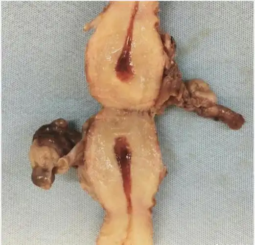 子宫内膜异位症