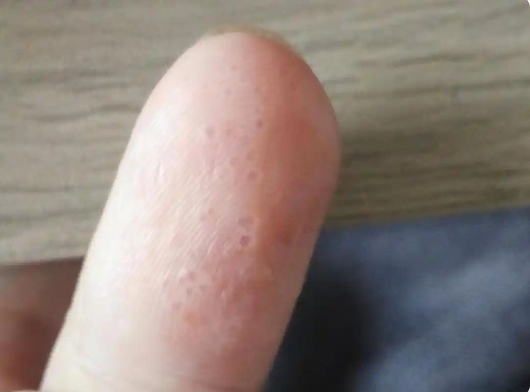 手上起小水泡,又痒又痒又脱皮怎么办,医生教你应对小妙招