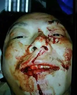 和别人打架手筋被切断了怎么办?一直在流血打架受伤流血照片 (第1页)