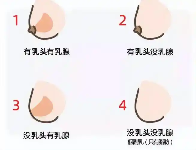 看凸起处是否存在乳头,乳晕,或像痣一样的黑点,存在则可能为真副乳;2