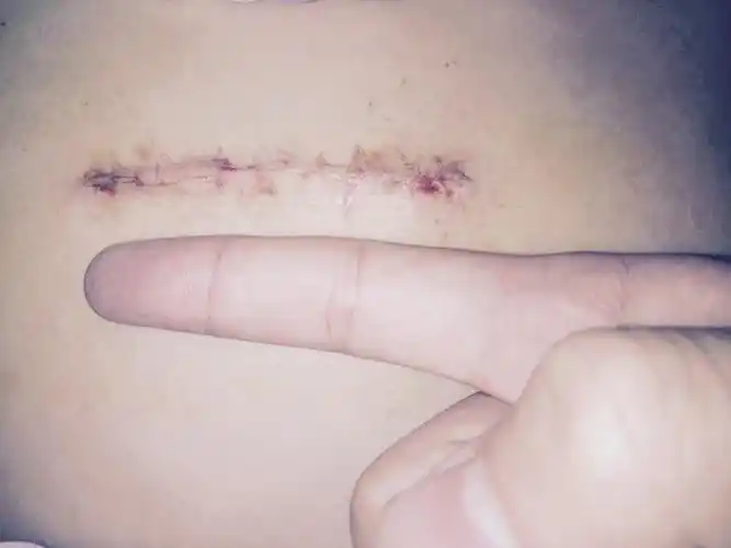 小切口复杂心脏瓣膜手术 - 好大夫在线