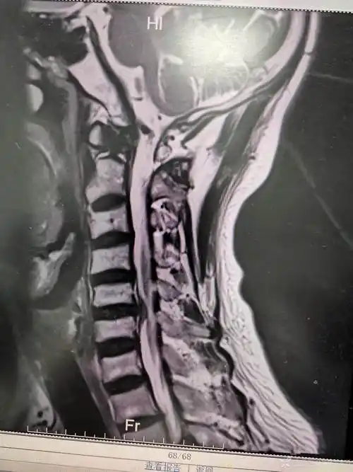 看看颈椎磁共振患者有手麻需要手术治疗吗