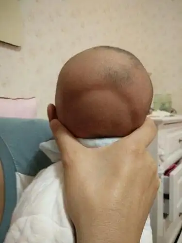 宝宝后脑勺为什么会这样