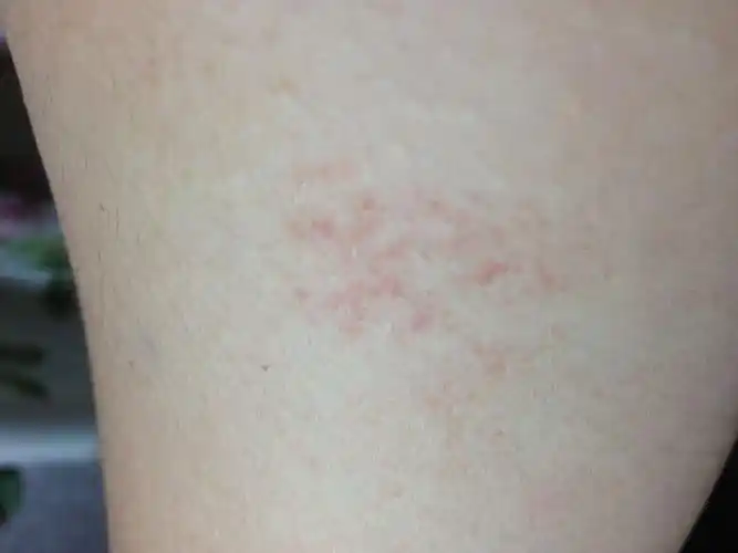 p>皮下出血点是指人体内 a target="_blank" href="/item/毛细血管