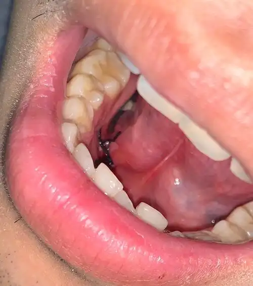 我的舌下腺囊肿治疗全记录