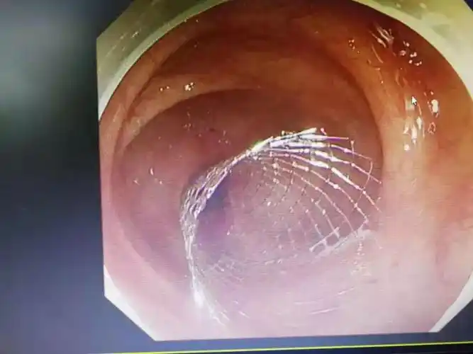 便秘的老年人要注意这种肚子疼没那么简单