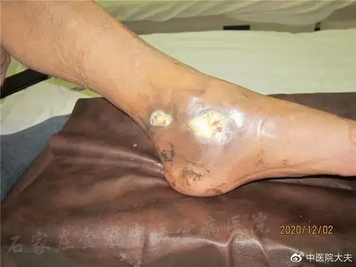 河北省承德市谭先生左足跗骨骨结核治疗病例