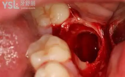 网友1386516提问拔过智齿后有一个洞怎么办