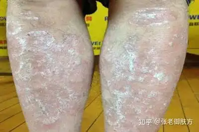 哪种人容易患皮肤病