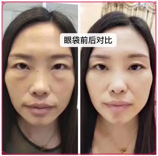 科普去眼袋淤青多久能好?怎么做能缩短眼袋手术后的恢复期?