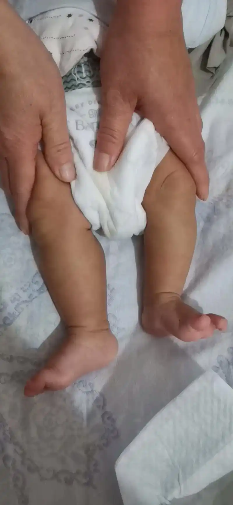 有没有儿科专家啊,看看我家宝宝的腿为什么一条腿粗长,一条腿细 - 抖