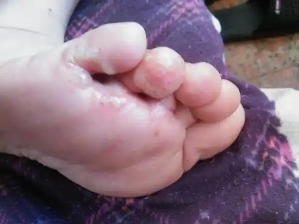 得了脚气该如何治疗?_金华婺城皮肤病防治院【官网】