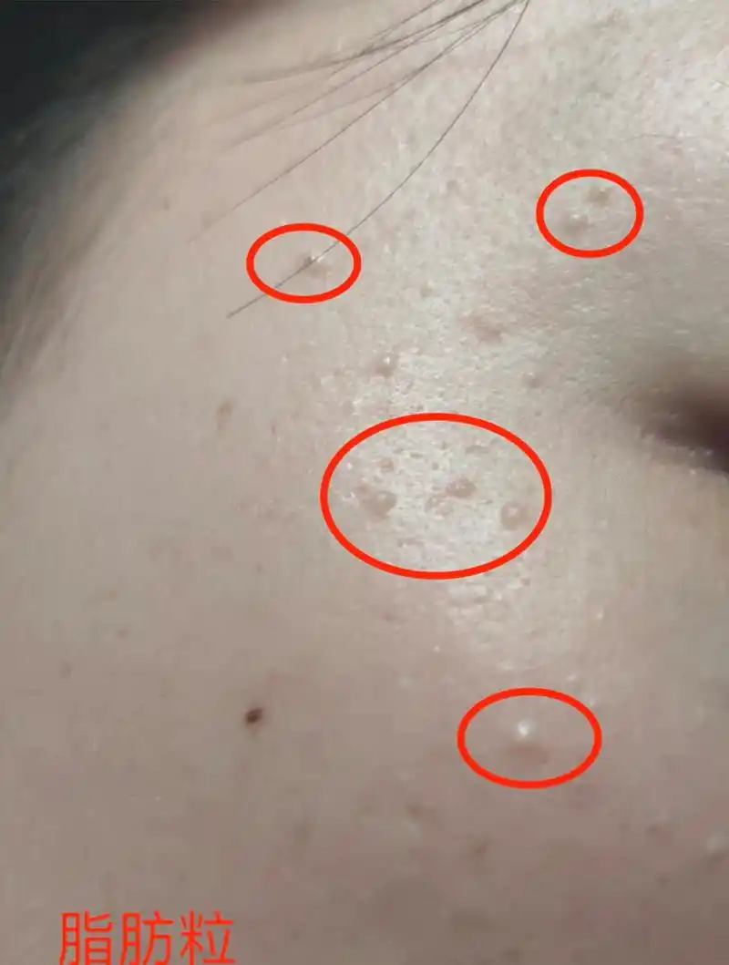 脸上的脂肪粒会自动消失吗?