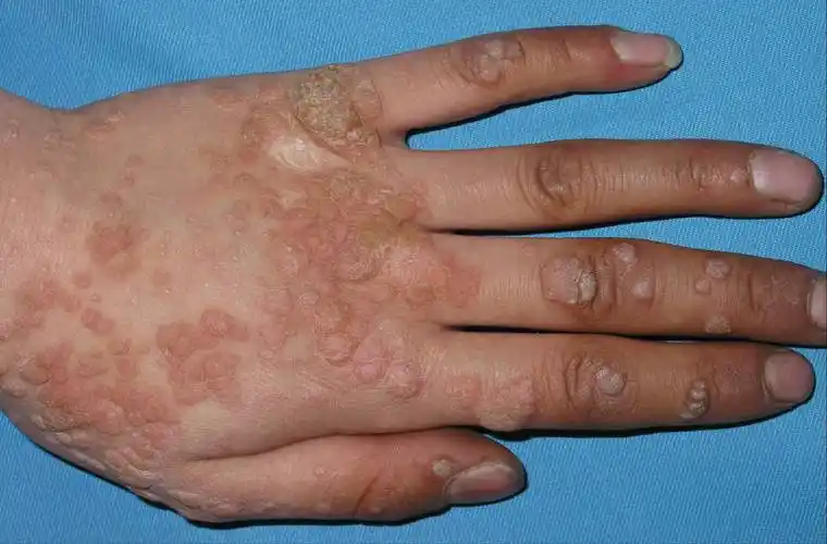 皮肤科主任医师 教授孟昭影样痣及智力发育迟缓;患者可有家族史,病程