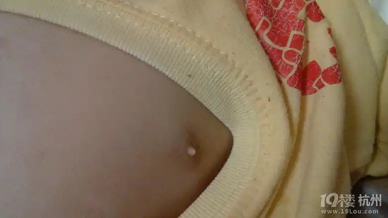 右边乳头有白色突出来了.是不是发育了?