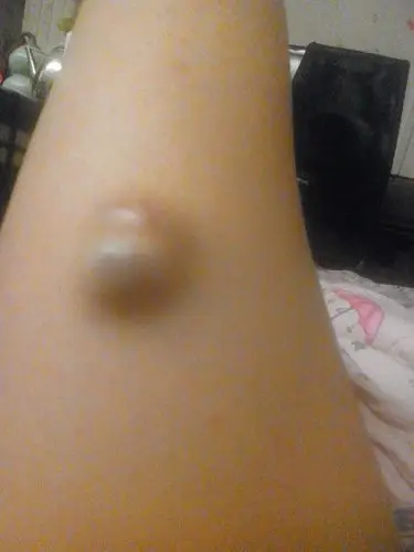 大腿上长了这样一个包,已经七八年了,记得最早的时候是一颗小红点被我