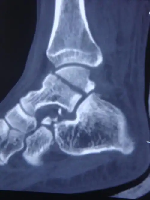 足部骨折-1 距骨骨折图片 - 好大夫在线